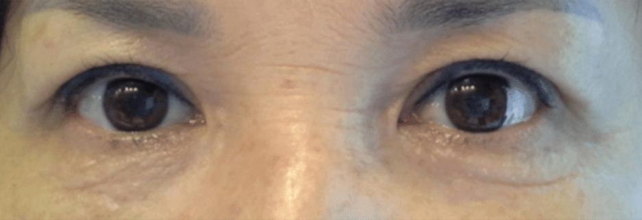 After: Upper blepharoplasty for a woman in her 60s, two months after surgery