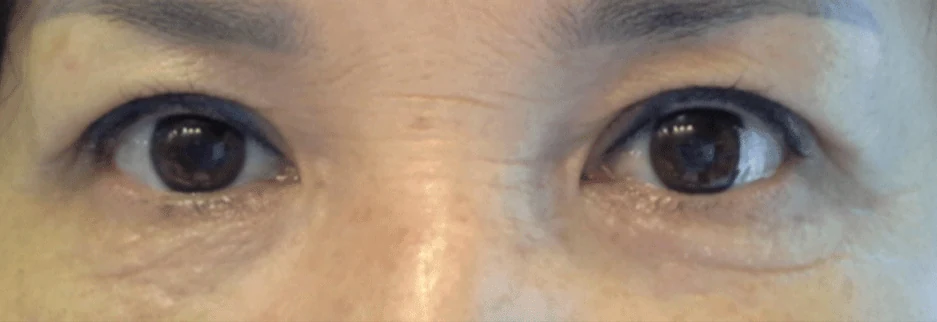 After: Upper blepharoplasty for a woman in her 60s, two months after surgery