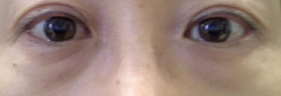 Before: Under eye fat repositioning, one month after surgery