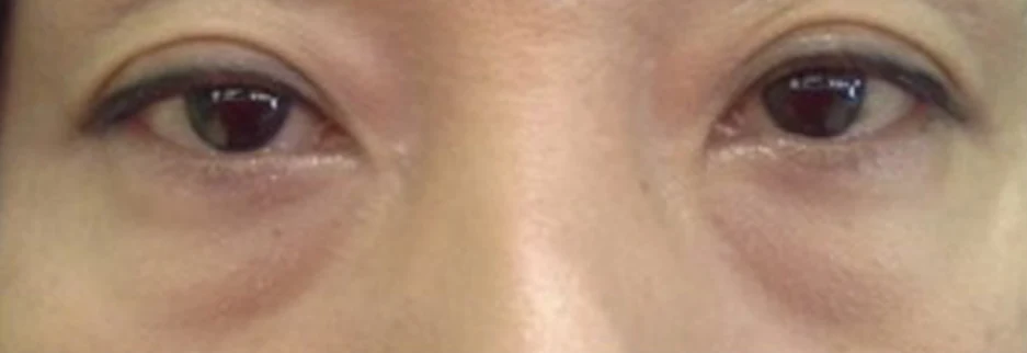 Before: Under eye fat repositioning, one month after surgery