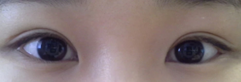 After: Revision surgery to lower a high fold, two months after surgery