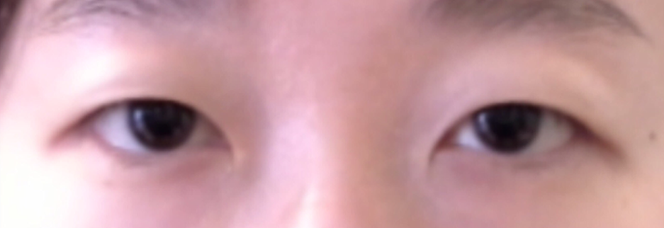 Before: Incisional ptosis correction, one month after surgery