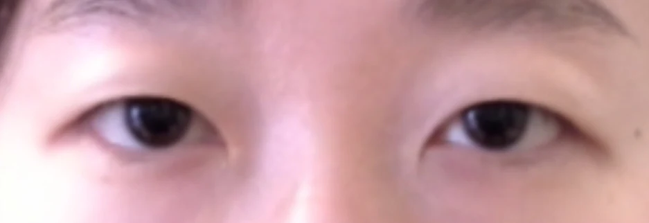 Before: Incisional ptosis correction, one month after surgery