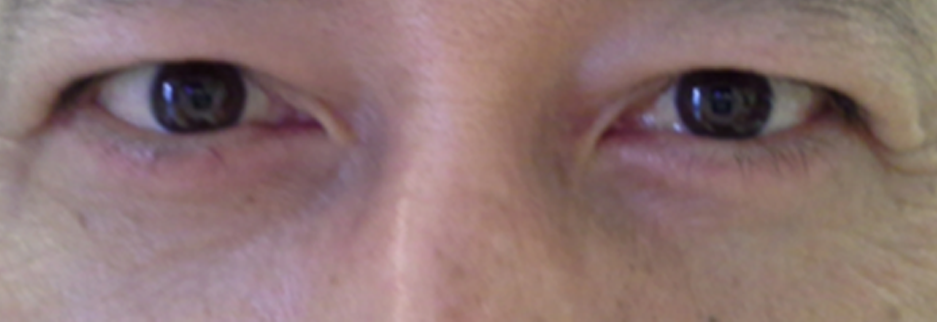 After: Lower blepharoplasty for a man in his 50s, two weeks after surgery