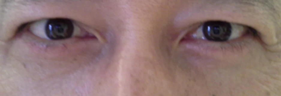 After: Lower blepharoplasty for a man in his 50s, two weeks after surgery