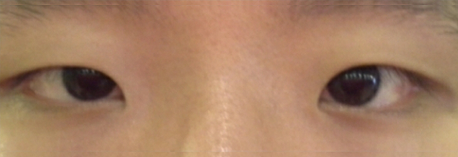 Before: Men's incisional ptosis correction, two months after surgery