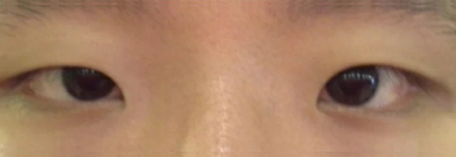 Before: Men's incisional ptosis correction, two months after surgery