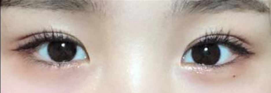 After: Incisional ptosis correction with lateral canthoplasty, two months after surgery