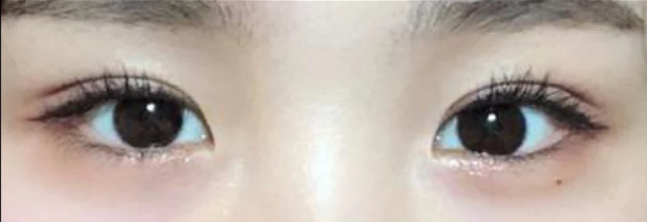 After: Incisional double eyelid surgery with ptosis correction, two months after surgery