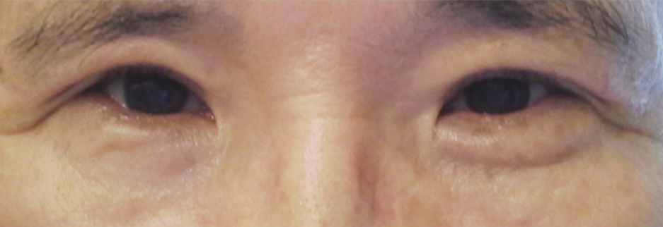 After: Upper blepharoplasty for a man in his 50s, three months after surgery
