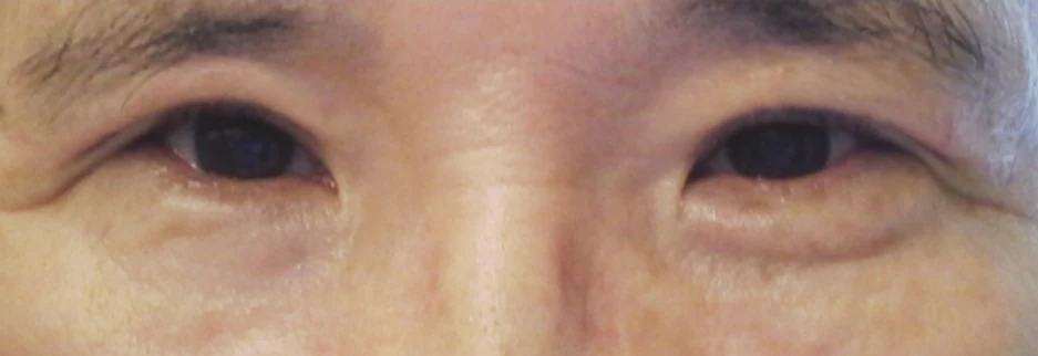 After: Upper blepharoplasty for a man in his 50s, three months after surgery