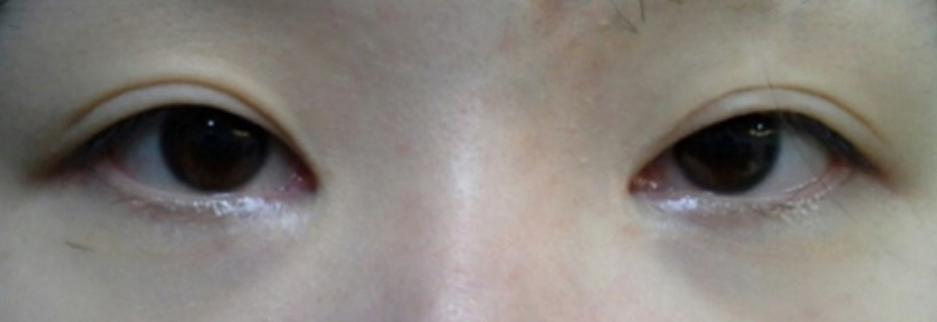 Before: Revision surgery for a loosened fold, two months after surgery