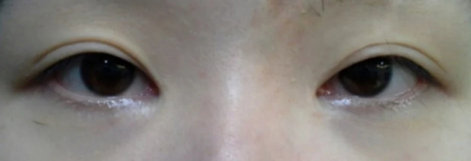 Before: Revision surgery for a loosened fold, two months after surgery