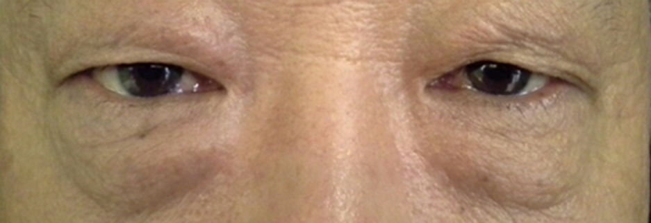 Before: Lower blepharoplasty for a man in his 70s, four days after surgery