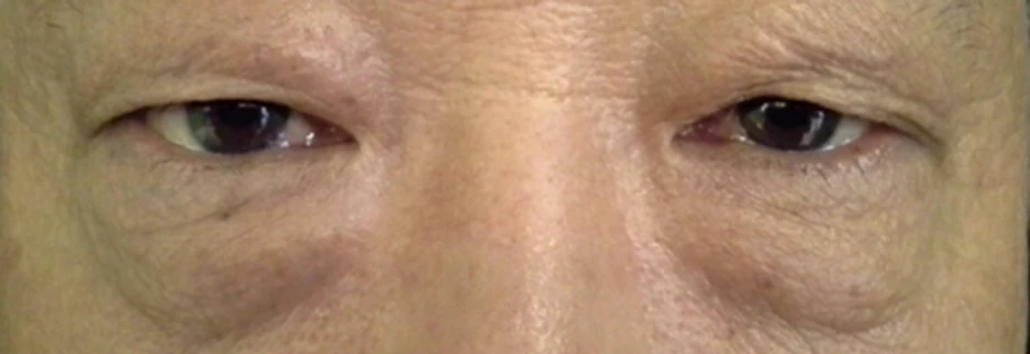 Before: Lower blepharoplasty for a man in his 70s, four days after surgery