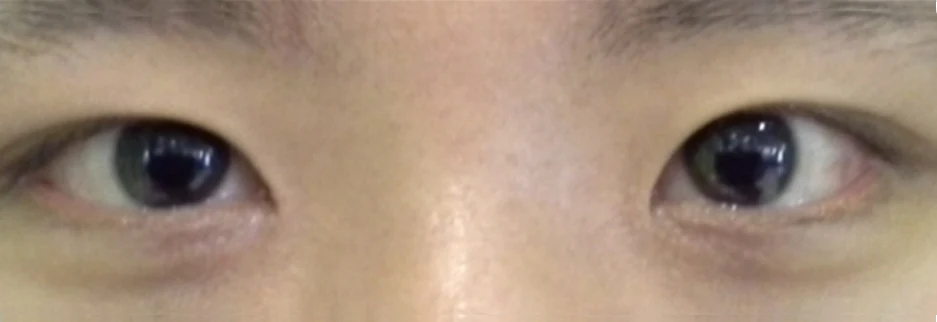 After: Men's incisional ptosis correction, two months after surgery