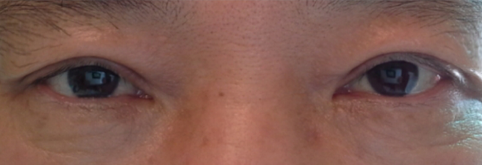 After: Upper blepharoplasty for a man in his 50s, three months after surgery