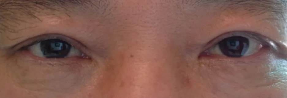 After: Upper blepharoplasty for a man in his 50s, three months after surgery