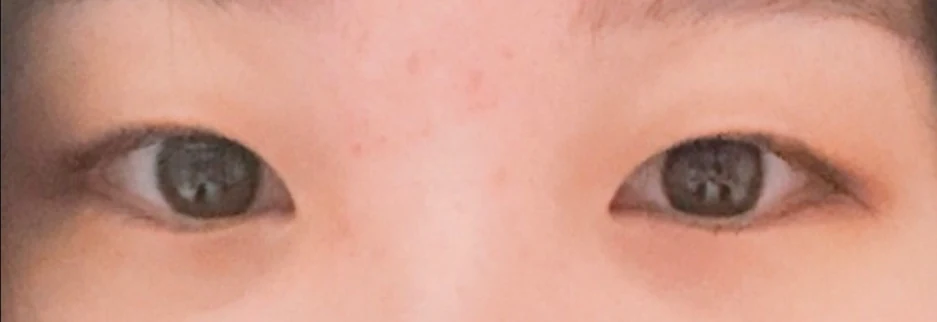 Before: Incisional double eyelid surgery with ptosis correction, two months after surgery