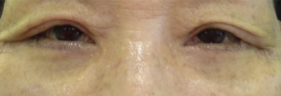 After: Lower blepharoplasty for a woman in her 60s, four days after surgery