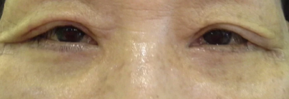 After: Lower blepharoplasty for a woman in her 60s, four days after surgery