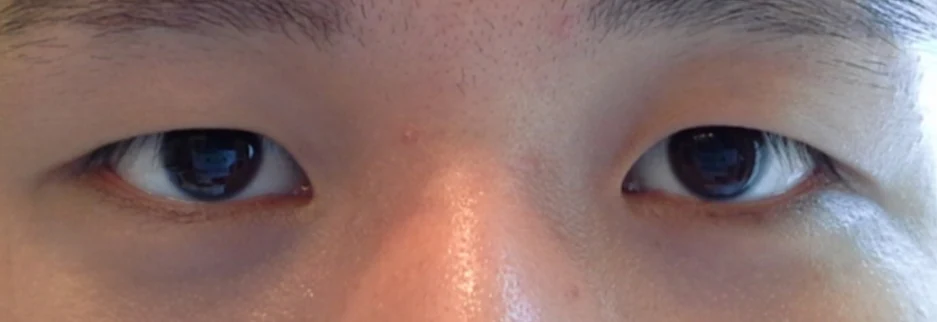 Before: Men's incisional ptosis correction, two months after surgery