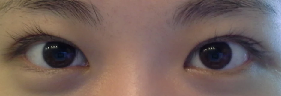 After: Incisional double eyelid surgery with ptosis correction, two months after surgery