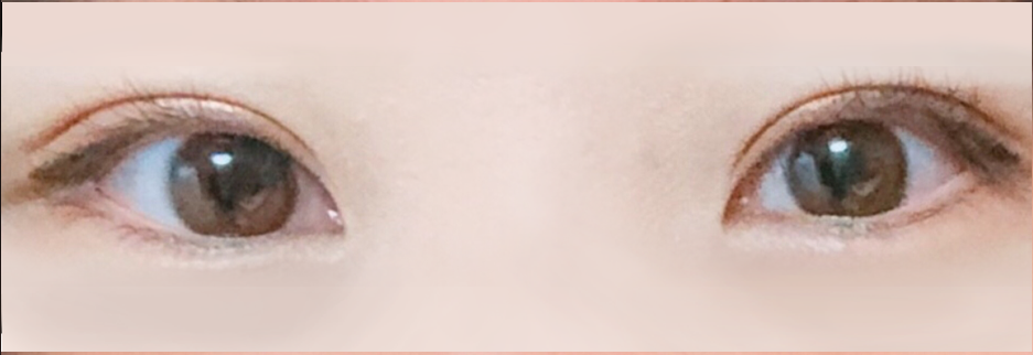 After: Incisional ptosis correction with lateral canthoplasty, two months after surgery
