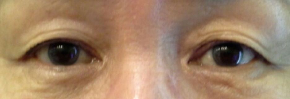 Before: Upper blepharoplasty for a woman in her 60s, two months after surgery