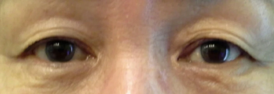 Before: Upper blepharoplasty for a woman in her 60s, two months after surgery