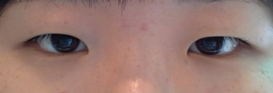 Before: Epicanthoplasty, one month after surgery