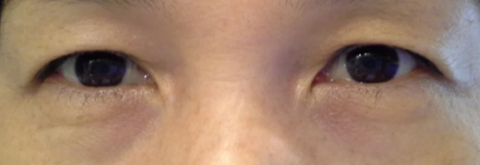 Before: Upper blepharoplasty for a woman in her 50s, three months after surgery