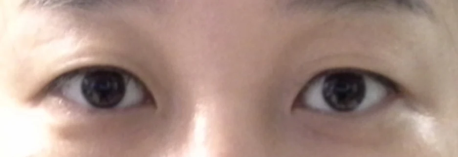 Before: Upper blepharoplasty for a woman in her 40s, two months after surgery