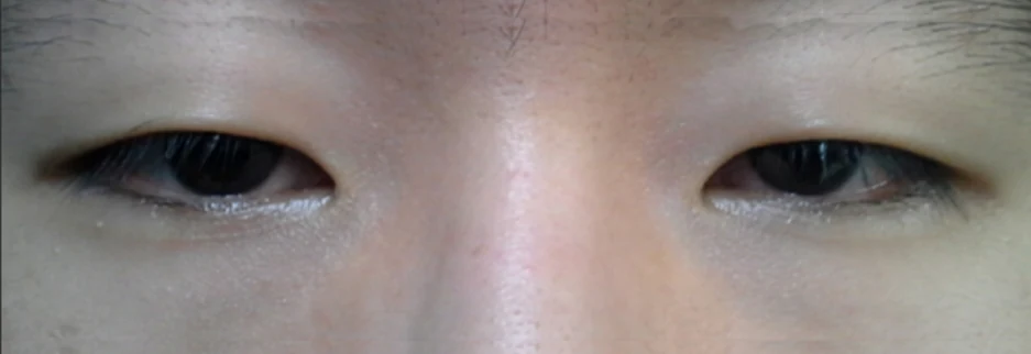 Before: Men's incisional ptosis correction, two months after surgery