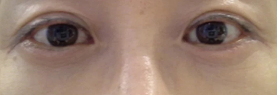 After: Under eye fat repositioning, one month after surgery