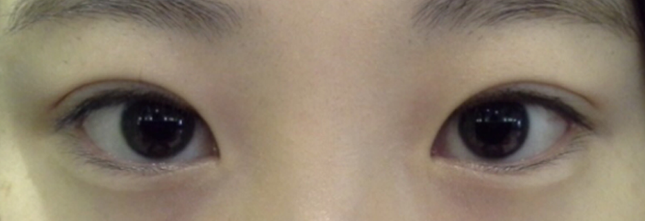 After: Incisional ptosis correction, one month after surgery