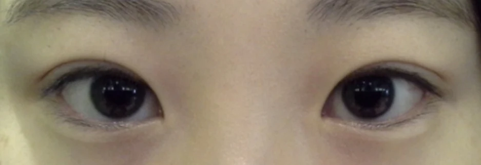 After: Incisional ptosis correction, one month after surgery
