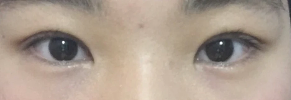 After: Incisional double eyelid surgery with ptosis correction, three weeks after surgery