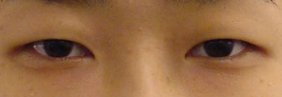 Before: Incisional double eyelid surgery with ptosis correction, one month after surgery