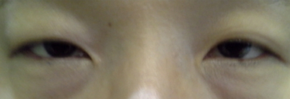 Before: Upper blepharoplasty for a woman in her 50s, two months after surgery