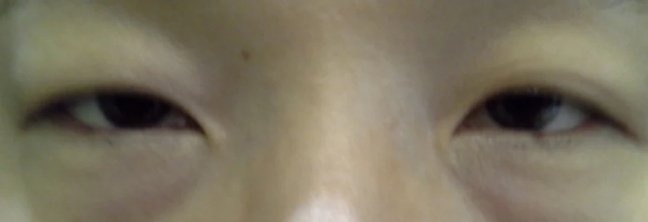 Before: Upper blepharoplasty for a woman in her 50s, two months after surgery