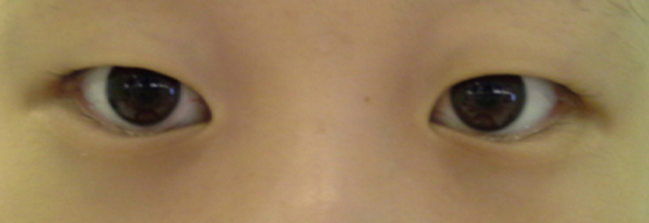 Before: Epicanthoplasty, one month after surgery