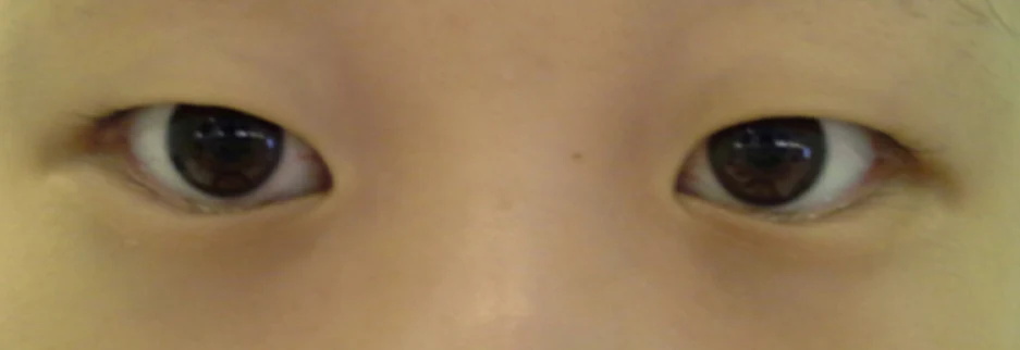 Before: Epicanthoplasty, one month after surgery