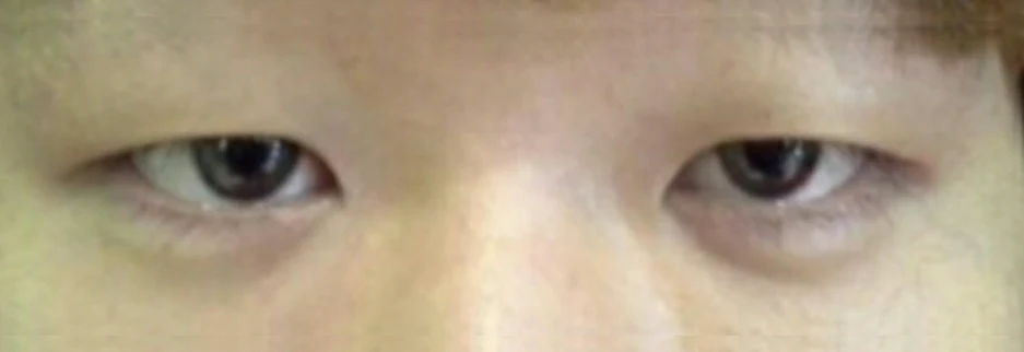 Before: Men's incisional ptosis correction, two months after surgery
