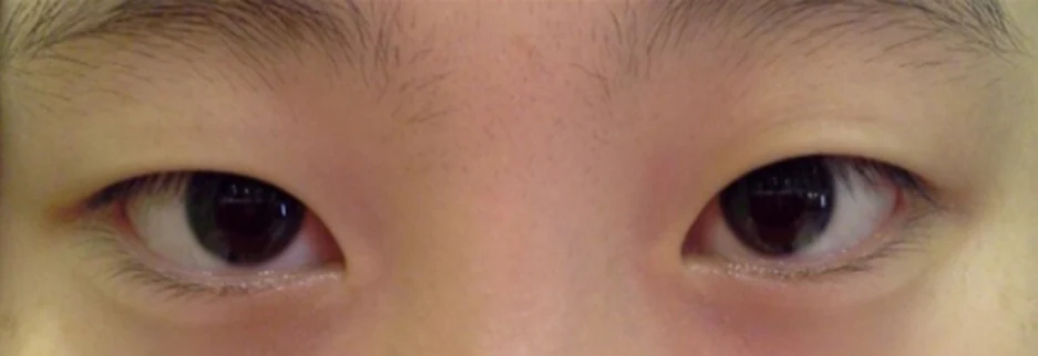 Before: Incisional ptosis correction, one month after surgery