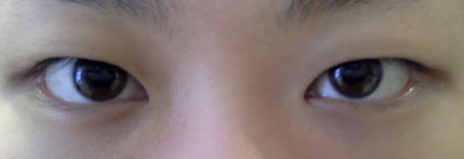 Before: Incisional double eyelid surgery with ptosis correction, two months after surgery