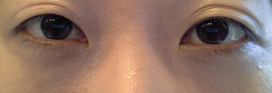 After: Under eye fat repositioning, one month after surgery