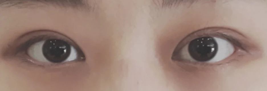 After: Non incisional double eyelid with ptosis correction, one month after surgery