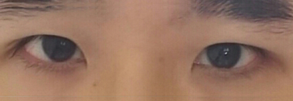 After: Men's incisional ptosis correction, two months after surgery
