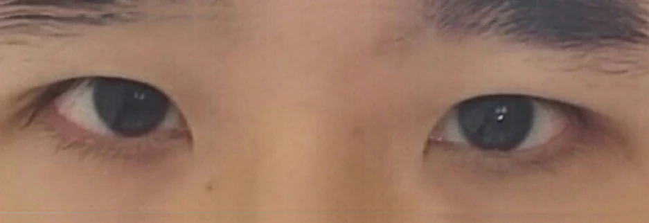 After: Men's incisional ptosis correction, two months after surgery